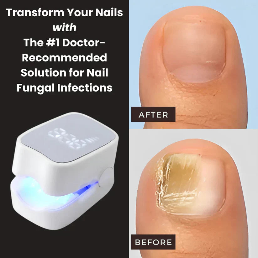 TopNext™ - Nail Fungus Laser Device